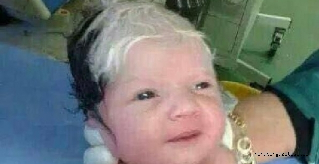 Suriyede Bir Bebek, Siyah-Beyaz Saçla Doğdu!